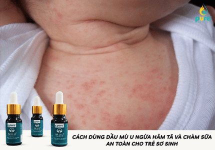 Cách dùng dầu mù u ngừa hăm tã và chàm sữa an toàn cho trẻ sơ sinh