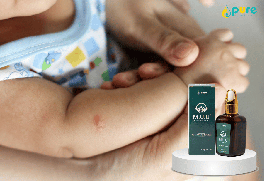 Cách làm dịu vết côn trùng cắn cho bé bằng dầu mù u M.U.U dịu nhẹ