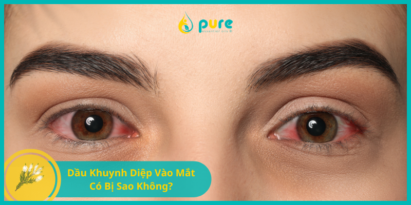 Dầu Khuynh Diệp Vào Mắt Có Bị Sao Không?