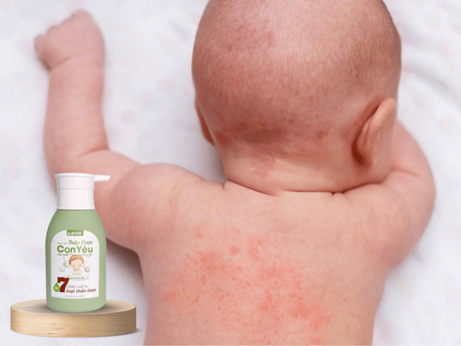 Giảm mẩn ngứa cho bé bằng nước tắm thảo dược