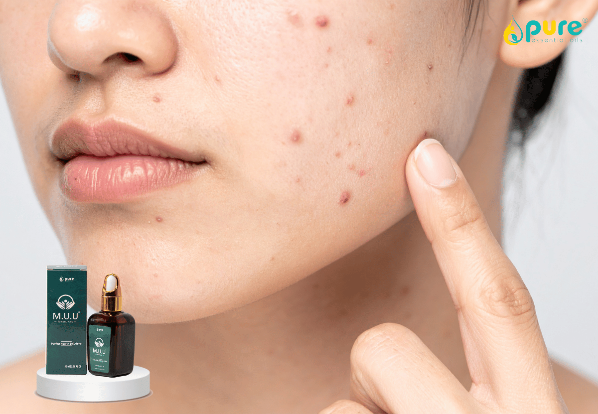 Hướng dẫn cách trị sẹo rỗ và vết thâm bằng dầu mù u M.U.U tại nhà