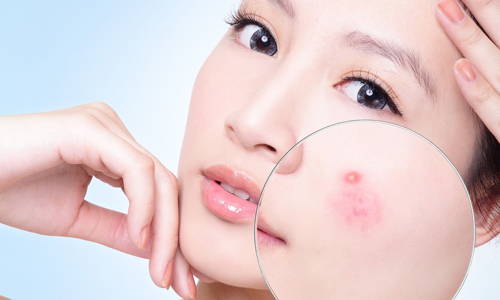 Kem Mụn Mai Ceuticals giúp ngừa mụn có hiệu quả không?