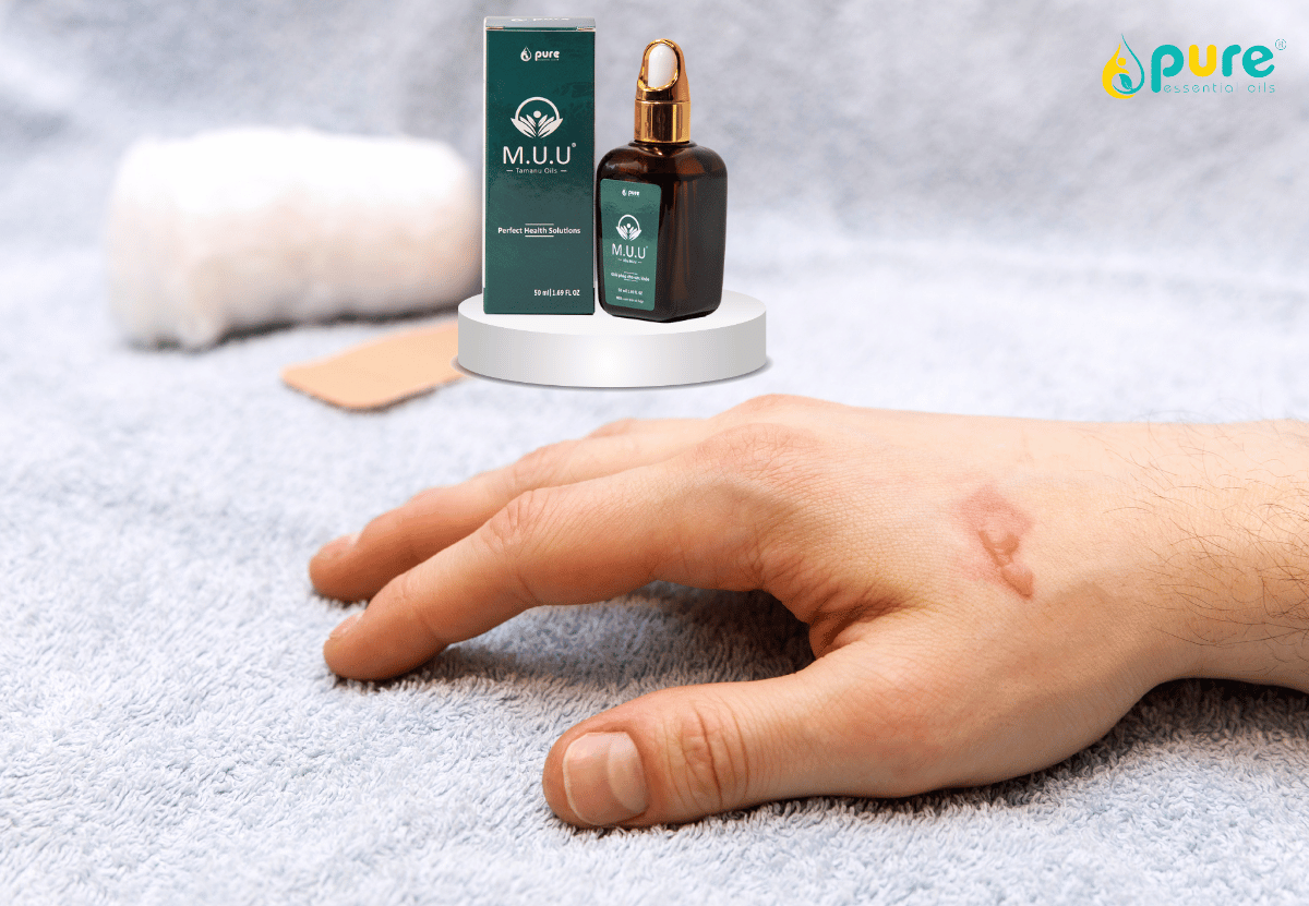 Tại sao dầu mù u M.U.U là khắc tinh của các vết bỏng và vết thương hở?